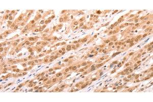 Immunohistochemistry of paraffin-embedded Human esophagus cancer tissue using TAX1BP1 Polyclonal Antibody at dilution 1:60 (TAX1BP1 anticorps)