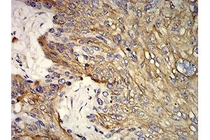 Immunohistochemical analysis of paraffin-embedded esophageal cancer tissues using KRT10 mouse mAb with DAB staining.
