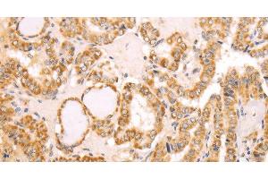 Immunohistochemistry of paraffin-embedded Human thyroid cancer using NAMPT Polyclonal Antibody at dilution of 1:30 (NAMPT anticorps)