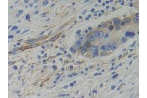 Detection of WARS in Human Prostate cancer Tissue using Polyclonal Antibody to Tryptophanyl tRNA Synthetase (WARS)