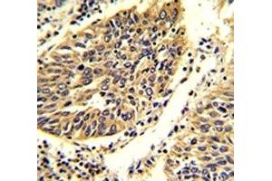 IHC analysis of FFPE human lung carcinoma stained with WNT4 antibody.