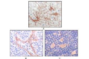 Immunohistochemical analysis of paraffin-embedded human cerebrum tumor (A), endothelium of vessel (B), lymphocyte of thymus(C), showing cytoplasmic localization using FES antibody with DAB staining. (FES anticorps)