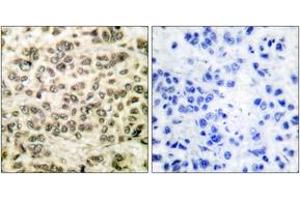 Immunohistochemistry analysis of paraffin-embedded human breast carcinoma tissue, using HDAC3 Antibody. (HDAC3 anticorps  (AA 379-428))