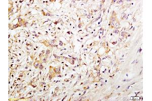 Formalin-fixed and paraffin embedded human gastric carcinoma tissue labeled with Anti-CD34 Polyclonal Antibody, Unconjugated at 1:200 followed by conjugation to the secondary antibody and DAB staining