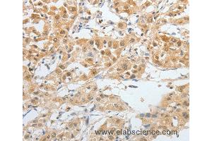 Immunohistochemistry of Human lung cancer using BPIFB2 Polyclonal Antibody at dilution of 1:45 (BPIL1 anticorps)