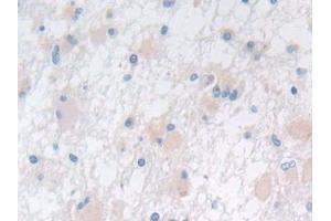 Detection of PAP in Human Glioma Tissue using Polyclonal Antibody to Prostatic Acid Phosphatase (PAP) (ACPP anticorps  (AA 217-386))