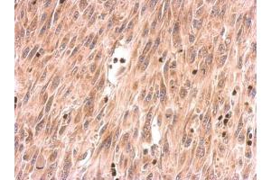 IHC-P Image SOS2 antibody detects SOS2 protein at cytosol on U87 xenograft by immunohistochemical analysis.