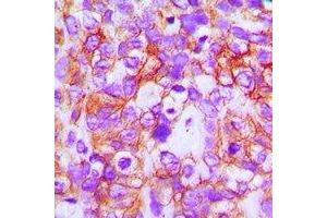 Immunohistochemical analysis of ABCB5 staining in human breast cancer formalin fixed paraffin embedded tissue section. (ABCB5 anticorps)
