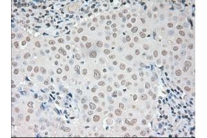 Immunohistochemical staining of paraffin-embedded liver tissue using anti-VEGFmouse monoclonal antibody. (VEGF anticorps  (AA 27-233))