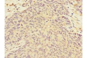 Immunohistochemistry of paraffin-embedded human ovarian cancer using ABIN7149955 at dilution of 1:100 (FMO2 anticorps  (AA 210-470))