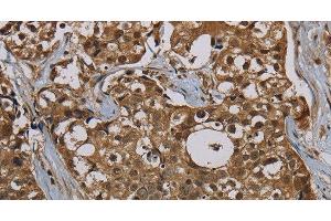 Immunohistochemistry of paraffin-embedded Human breast cancer tissue using PNN Polyclonal Antibody at dilution 1:50 (PNN anticorps)