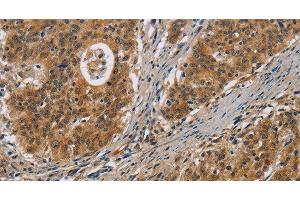 Immunohistochemistry of paraffin-embedded Human gastric cancer tissue using IL17D Polyclonal Antibody at dilution 1:50 (IL17D anticorps)