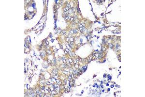 Immunohistochemistry of paraffin-embedded Human colon carcinoma using TXNDC9 Rabbit pAb  at dilution of 1:100 (40x lens). (TXNDC9 anticorps  (AA 1-110))