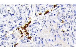 Detection of CASP1 in Human Ovarian cancer Tissue using Polyclonal Antibody to Caspase 1 (CASP1)