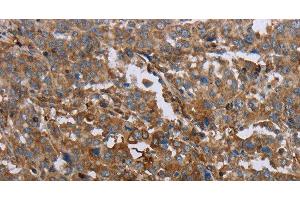 Immunohistochemistry of paraffin-embedded Human liver cancer using GCK Polyclonal Antibody at dilution of 1:40 (GCK anticorps)
