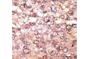 IHC analysis of FFPE human hepatocarcinoma tissue stained with the anti-ATG5 antibody (ATG5 anticorps  (AA 209-238))