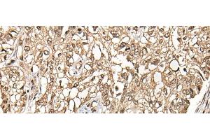 Immunohistochemistry of paraffin-embedded Human lung cancer tissue using CHFR Polyclonal Antibody at dilution of 1:35(x200) (CHFR anticorps)