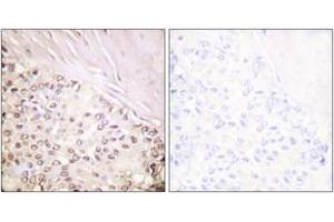 Immunohistochemistry analysis of paraffin-embedded human breast carcinoma tissue, using FANCD2 (Ab-222) Antibody. (FANCD2 anticorps  (AA 188-237))