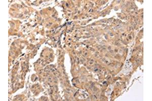 The image on the left is immunohistochemistry of paraffin-embedded Human breast cancer tissue using ABIN7190290(CLDND2 Antibody) at dilution 1/45, on the right is treated with synthetic peptide. (CLDND2 anticorps)