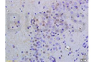 Formalin-fixed and paraffin embedded human colorectal cancer labeled with Anti OCT4B-190 Polyclonal Antibody, Unconjugated (ABIN704531) at 1:200 followed by conjugation to the secondary antibody and DAB staining (Oct-4BOCT4B-190NT (AA 201-300) anticorps)