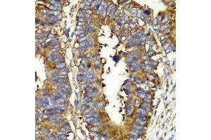 Immunohistochemistry of paraffin-embedded human colon carcinoma using QARS antibody. (QARS anticorps  (AA 1-250))