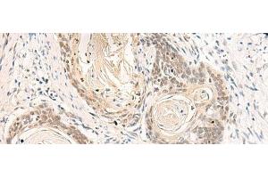 Immunohistochemistry of paraffin-embedded Human esophagus cancer tissue using DPPA4 Polyclonal Antibody at dilution of 1:55(x200) (DPPA4 anticorps)