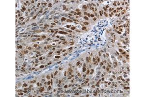 Immunohistochemistry of Human ovarian cancer using MCM3 Polyclonal Antibody at dilution of 1:30 (MCM3 anticorps)