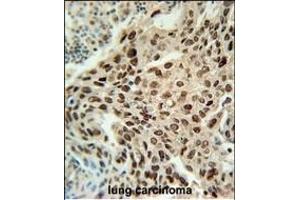 PRNIP Antibody (C-term) (ABIN651984 and ABIN2840482) immunohistochemistry analysis in formalin fixed and paraffin embedded human lung carcinoma followed by peroxidase conjugation of the secondary antibody and DAB staining. (ERI3 anticorps  (C-Term))