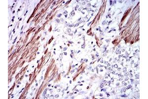 Immunohistochemical analysis of paraffin-embedded rectum cancer tissues using GSTM1 mouse mAb with DAB staining.