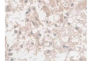 Detection of NSE in Human Glioma Tissue using Monoclonal Antibody to Enolase, Neuron Specific (NSE)