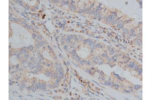 ABIN6268647 at 1/200 staining human lung cancer tissue sections by IHC-P. (TSC1 anticorps  (C-Term))