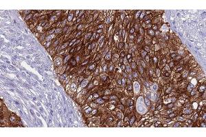 ABIN6268995 at 1/100 staining Human urothelial cancer tissue by IHC-P. (TGFBR2 anticorps  (Internal Region))