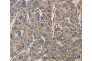 Immunohistochemistry of Human gastric cancer using IRAK4 Polyclonal Antibody at dilution of 1:40