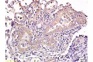 Formalin-fixed and paraffin embedded human gastric cancer labeled with Anti CD1a/Cortical thymocyte antigen CD1A Polyclonal Antibody, Unconjugated  at 1:300 followed by conjugation to the secondary antibody and DAB staining