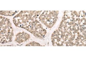 Immunohistochemistry of paraffin-embedded Human esophagus cancer tissue using CAPN15 Polyclonal Antibody at dilution of 1:50(x200) (Calpain 15/SOLH anticorps)
