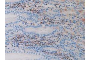 IHC-P analysis of Human Stomach Cancer Tissue, with DAB staining. (ADAM10 anticorps  (AA 420-641))