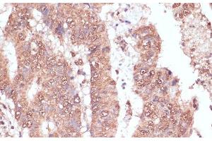 Immunohistochemistry of paraffin-embedded Human colon carcinoma using RAD50 Polyclonal Antibody at dilution of 1:100 (40x lens).