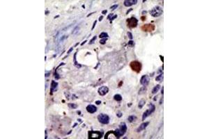 Formalin-fixed and paraffin-embedded human cancer tissue reacted with the primary antibody, which was peroxidase-conjugated to the secondary antibody, followed by AEC staining. (PSMD4/ASF anticorps  (C-Term))