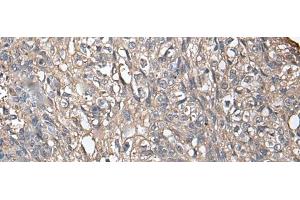 Immunohistochemistry of paraffin-embedded Human lung cancer tissue using NDUFB5 Polyclonal Antibody at dilution of 1:45(x200) (NDUFB5 anticorps)