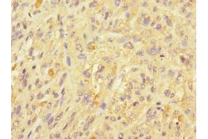 Immunohistochemistry of paraffin-embedded human melanoma using ABIN7174484 at dilution of 1:100 (UBE2S anticorps  (AA 1-222))