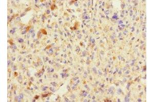 Immunohistochemistry of paraffin-embedded human melanoma using ABIN7151292 at dilution of 1:100 (TRIP12 anticorps  (AA 1-240))