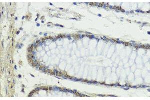 Immunohistochemistry of paraffin-embedded Human colon using Snail Polyclonal Antibody at dilution of 1:100 (40x lens).