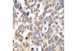 Immunohistochemistry of paraffin-embedded human esophageal cancer using PARN antibody at dilution of 1:100 (x40 lens). (PARN anticorps)