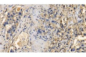 Detection of TGFb1 in Human Lung cancer Tissue using Polyclonal Antibody to Transforming Growth Factor Beta 1 (TGFb1)