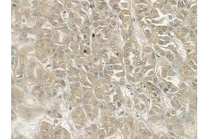ABIN6262942 and ABIN6272945 at 1/100 staining human renal cell carcinoma by IHC-P. (LDHB anticorps  (N-Term))