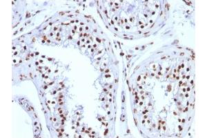 Formalin-fixed, paraffin-embedded human Testicular Carcinoma stained with Histone H1 Mouse Monoclonal Antibody (1415-1)