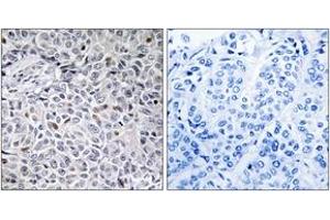 Immunohistochemistry analysis of paraffin-embedded human breast carcinoma tissue, using ZAP-70 (Ab-315) Antibody. (ZAP70 anticorps  (AA 281-330))