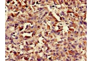 Immunohistochemistry of paraffin-embedded human melanoma using ABIN7155470 at dilution of 1:100 (ASH1L anticorps  (AA 1906-2160))