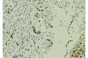 ABIN6272922 at 1/100 staining Human breast cancer tissue by IHC-P.