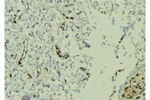 ABIN6272922 at 1/100 staining Human breast cancer tissue by IHC-P. (FERMT2 anticorps  (C-Term))